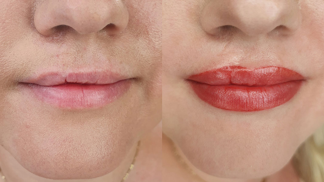 Pigmentierung einer Lippen-Kiefer-Gaumenspalte