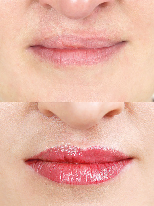 Pigmentierung einer Lippen-Kiefer-Gaumenspalte